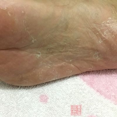 真菌感染也会导致脚臭
